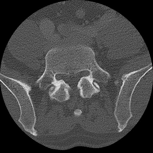 Benign post-traumatic pseudopneumoperitoneum (Radiopaedia 71199-81495 Axial bone window 274).jpg