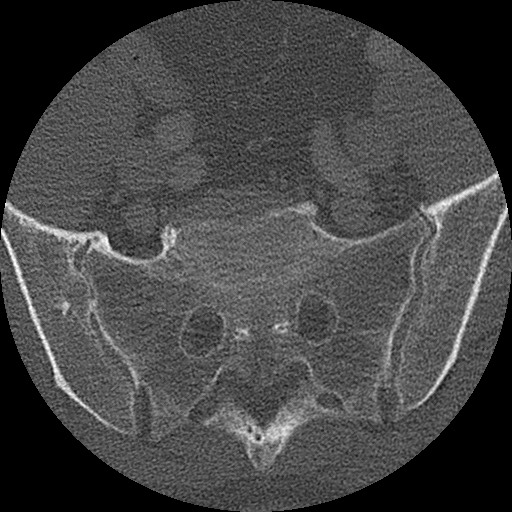 Benign post-traumatic pseudopneumoperitoneum (Radiopaedia 71199-81495 Axial bone window 293).jpg