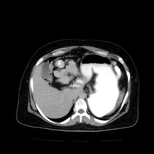File:Benign spindle cell tumor - abdominopelvic (Radiopaedia 61300-69212 Axial C+ delayed 14).jpg