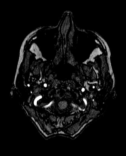 Berry aneurysm of the terminal internal carotid artery (Radiopaedia 88286-104918 Axial TOF 34).jpg