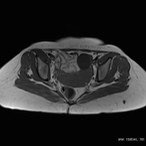 File:Bicornuate uterus- on MRI (Radiopaedia 49206-54297 Axial T1 9).jpg