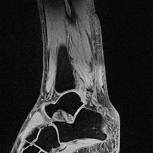 Bilateral Achilles tendon complete tear (Radiopaedia 81344-95051 Sagittal WE - Left 76).jpg