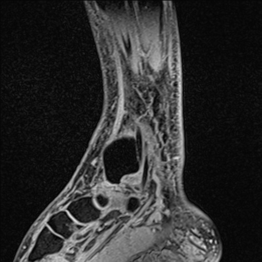 File:Bilateral Achilles tendon complete tear (Radiopaedia 81344-95051 Sagittal WE - Right 80).jpg