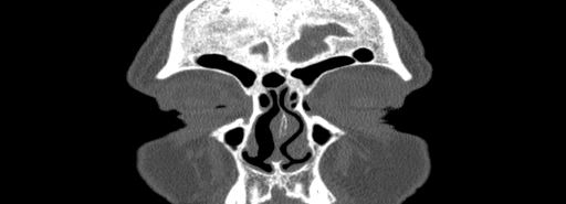 Bilateral Ectopic Infraorbital Nerves (Radiopaedia 49006-54084 Coronal bone window 2).jpg