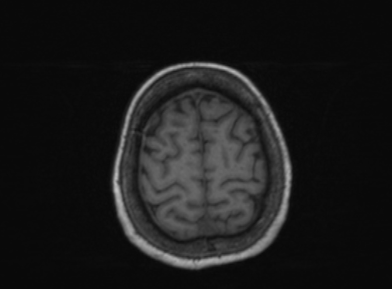 Bilateral PCA territory infarction - different ages (Radiopaedia 46200-51784 Axial T1 146).jpg