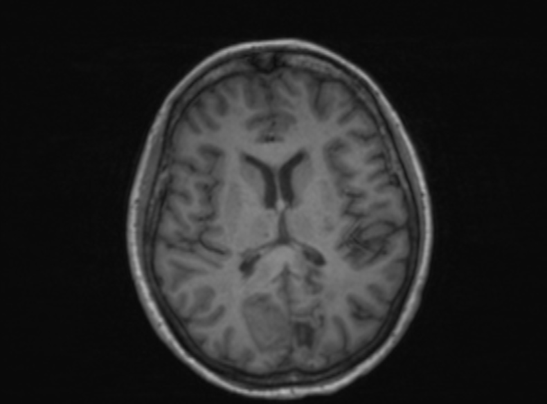 Bilateral PCA territory infarction - different ages (Radiopaedia 46200-51784 Axial T1 219).jpg