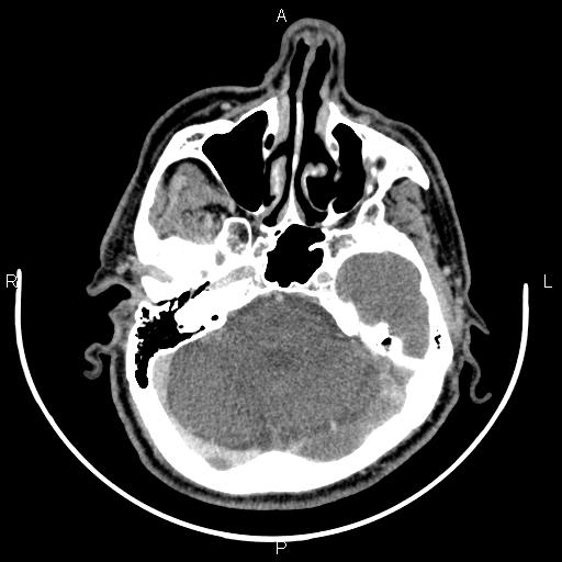 Bilateral Warthin tumors (Radiopaedia 84034-99263 Axial With contrast 5).jpg