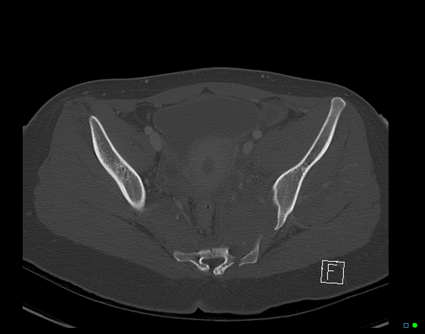 Bilateral acetabular fractures (Radiopaedia 79272-92308 Axial bone window 31).jpg