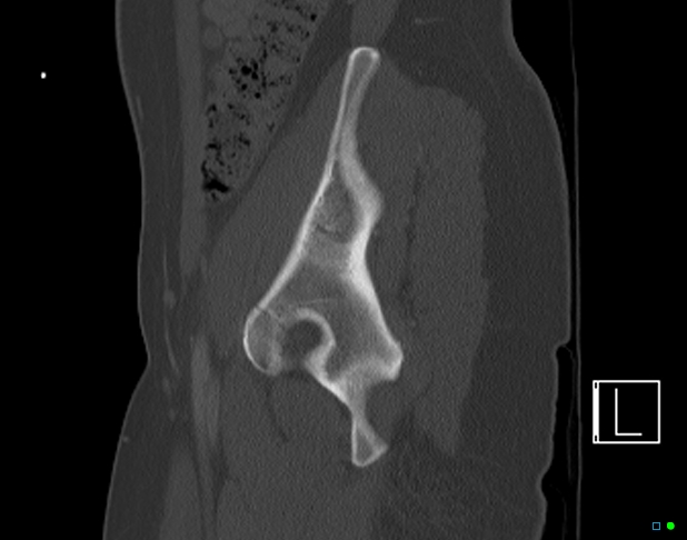 File:Bilateral acetabular fractures (Radiopaedia 79272-92308 Sagittal bone window 24).jpg