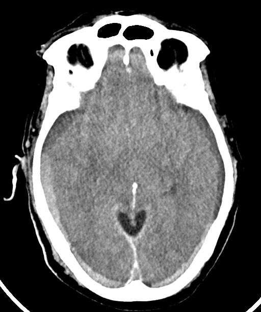 Bilateral acute on chronic subdural hematomas (Radiopaedia 78466-91146 Axial non-contrast 26).jpg