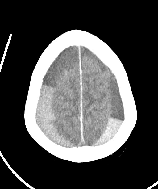 Bilateral acute on chronic subdural hematomas (Radiopaedia 78466-91146 Axial non-contrast 45).jpg