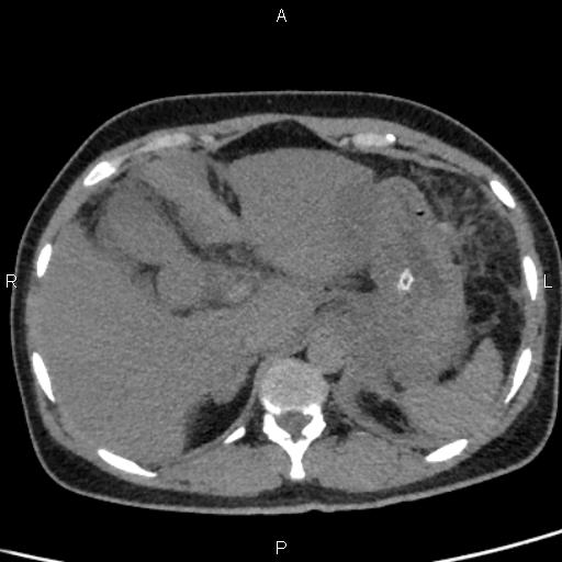 Bilateral adrenal gland hyperenhancement in pancreatitis (Radiopaedia 86642-102753 Axial non-contrast 23).jpg