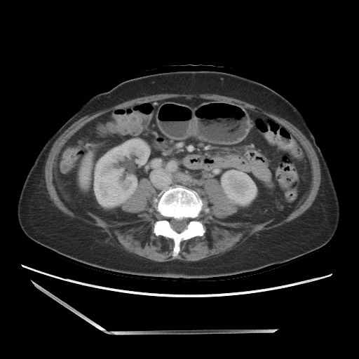 Bilateral adrenal granulocytic sarcomas (chloromas) (Radiopaedia 78375-91007 A 67).jpg
