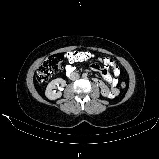 Bilateral adrenal myelolipoma (Radiopaedia 63058-71535 Axial C+ delayed 69).jpg