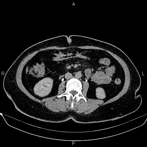 Bilateral benign adrenal adenomas (Radiopaedia 86912-103124 Axial C+ delayed 77).jpg