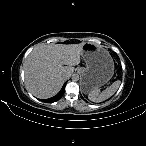 File:Bilateral benign adrenal adenomas (Radiopaedia 86912-103124 Axial non-contrast 26).jpg