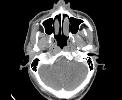File:Bilateral carotid body tumors (Radiopaedia 61841-69870 Axial Post contrast 7).jpg