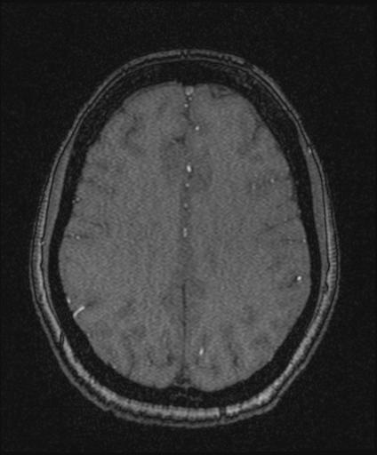 Bilateral carotid body tumors and right glomus jugulare tumor (Radiopaedia 20024-20060 Axial MRA 131).jpg