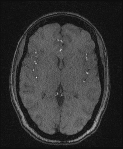 Bilateral carotid body tumors and right glomus jugulare tumor (Radiopaedia 20024-20060 Axial MRA 96).jpg