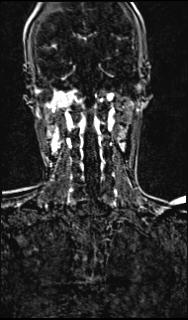 Bilateral carotid body tumors and right glomus jugulare tumor (Radiopaedia 20024-20060 MRA 118).jpg