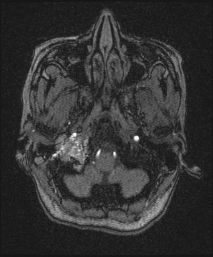 File:Bilateral carotid body tumors and right jugular paraganglioma (Radiopaedia 20024-20060 Axial 137).jpg