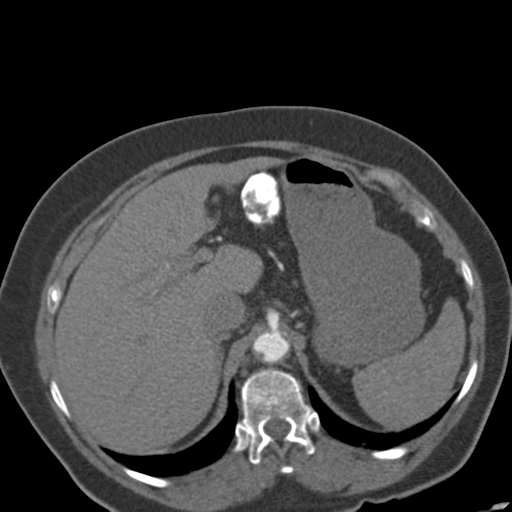 File:Bilateral delayed nephrogram from renal artery stenosis (Radiopaedia 47681-52362 A 14).png