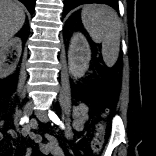 File:Bilateral delayed nephrogram from renal artery stenosis (Radiopaedia 47681-52362 B 19).png