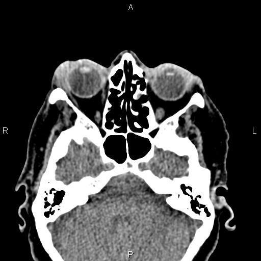 Bilateral enlargement of lacrimal glands - sarcoidosis (Radiopaedia 62627-70921 Axial non-contrast 37).jpg