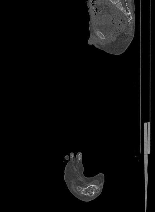 Bilateral fibular hemimelia type II (Radiopaedia 69581-79491 Sagittal bone window 45).jpg