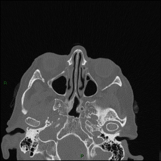 Bilateral frontal mucoceles (Radiopaedia 82352-96454 Axial bone window 169).jpg