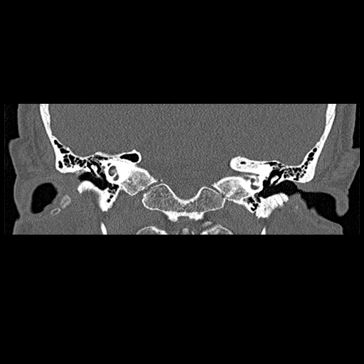 File:Bilateral ossifications of the external auditory canal (Radiopaedia 15233-15076 Coronal bone window 10).jpg