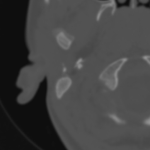 Bilateral otosclerosis (Radiopaedia 57237-64157 B 5).jpg