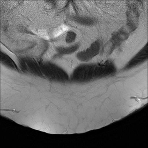 File:Bilateral ovarian dermoid cysts (Radiopaedia 90152-107338 Coronal T2 1).jpg