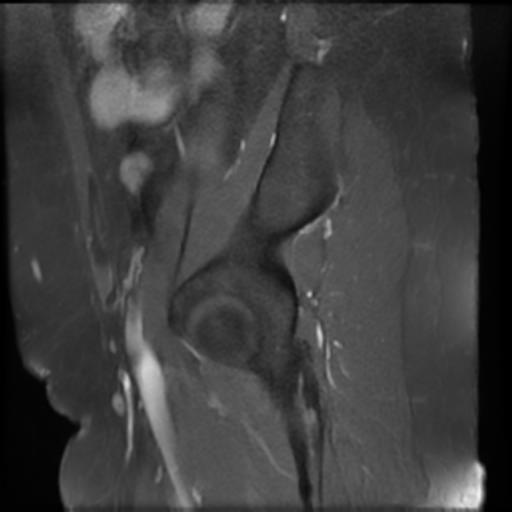 File:Bilateral ovarian dermoid cysts (Radiopaedia 90152-107338 Sagittal T1 C+ 24).jpg