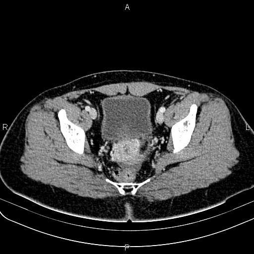 Bilateral ovarian teratoma (Radiopaedia 83131-97503 Axial With contrast 52).jpg