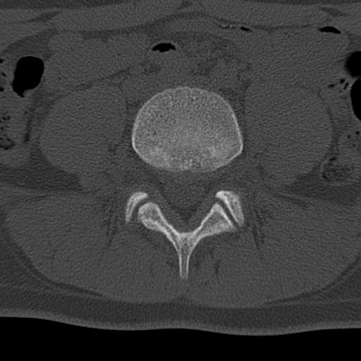 Bilateral pars defect (Radiopaedia 26691-26846 Axial bone window 38).jpg