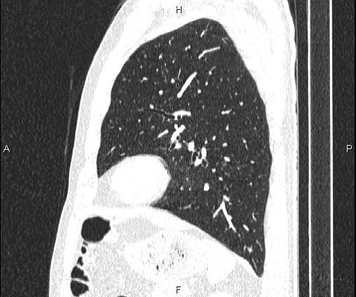 Bilateral pulmonary AVM (Radiopaedia 83134-97505 Sagittal lung window 81).jpg