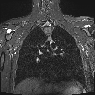 File:Bilateral spinoglenoid notch ganglion cysts (Radiopaedia 29577-30082 Coronal STIR 18).jpg