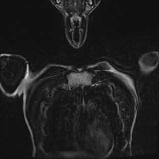 Bilateral spinoglenoid notch ganglion cysts (Radiopaedia 29577-30082 Coronal T2 16).jpg