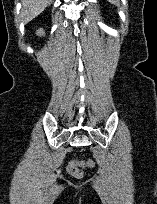 Bilateral staghorn calculi (Radiopaedia 59475-66842 Coronal non-contrast 84).jpg
