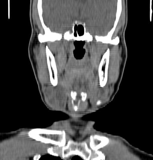 File:Bilateral submandibular sialolithiasis with sialadenitis (Radiopaedia 70721-80881 Coronal non-contrast 34).jpg