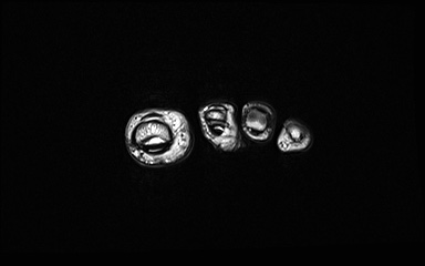 Bipartite hallux sesamoid diastasis (Radiopaedia 77133-89109 Coronal PD 44).jpg