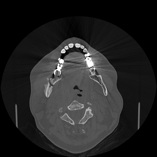File:Bisphosphonate-related osteonecrosis of the jaw (Radiopaedia 71324-81642 Axial bone window 76).jpg