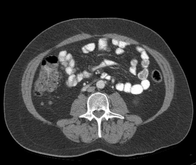 Bleeding duodenal ulcer and adenomyomatosis of gallbladder (Radiopaedia 61834-69861 A 71).jpg