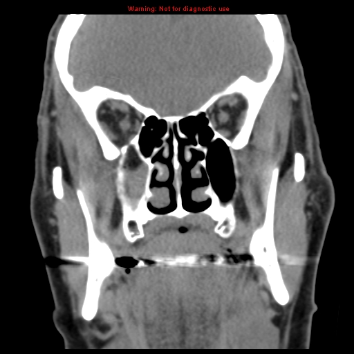 File:Blowout fracture with inferior rectus entrapment (Radiopaedia 12418-12673 Coronal non-contrast 16).jpg