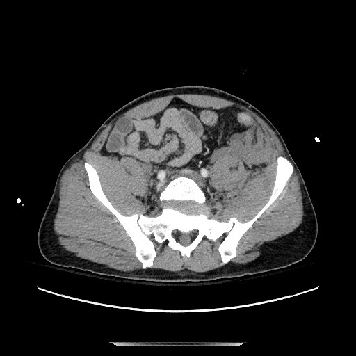 Blunt abdominal trauma with solid organ and musculoskelatal injury with active extravasation (Radiopaedia 68364-77895 A 116).jpg