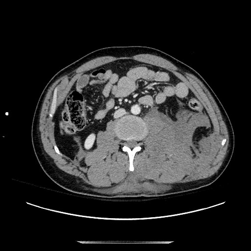 Blunt abdominal trauma with solid organ and musculoskelatal injury with active extravasation (Radiopaedia 68364-77895 A 76).jpg