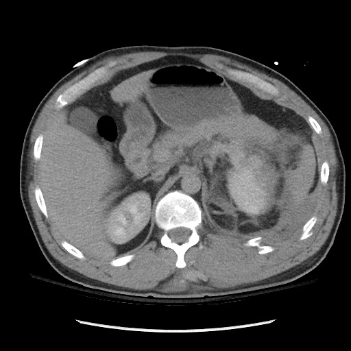 Blunt abdominal trauma with solid organ and musculoskelatal injury with active extravasation (Radiopaedia 68364-77895 Axial C+ delayed 40).jpg