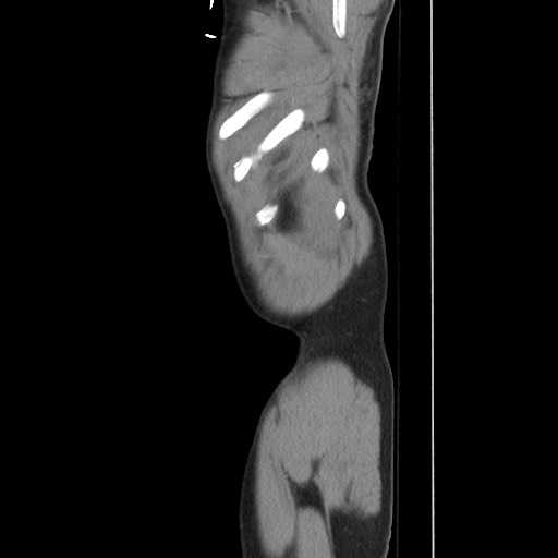 File:Blunt abdominal trauma with solid organ and musculoskelatal injury with active extravasation (Radiopaedia 68364-77895 C 135).jpg
