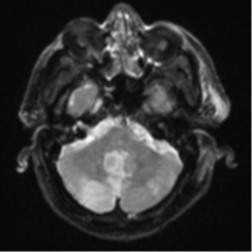 Blunt cerebrovascular injury (Radiopaedia 53682-59745 Axial DWI 8).png